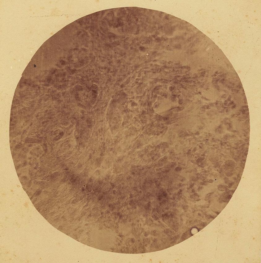 Dr. Samuel William Fletcher - Photo-Micrograph of Section of Cancer