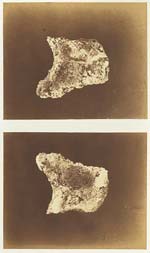 Adolphe Bertsch - Microscopic Study (Esquilles dos Maxillaire Necrose)