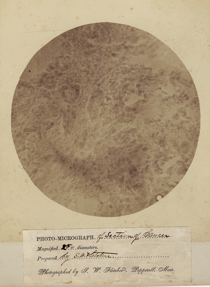 Photo-Micrograph of Section of Cancer